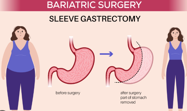 Exploring the Gastric Sleeve: A Proven Weight Loss Solution